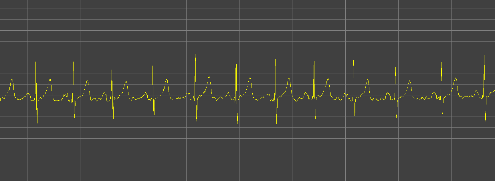 ECG low noise