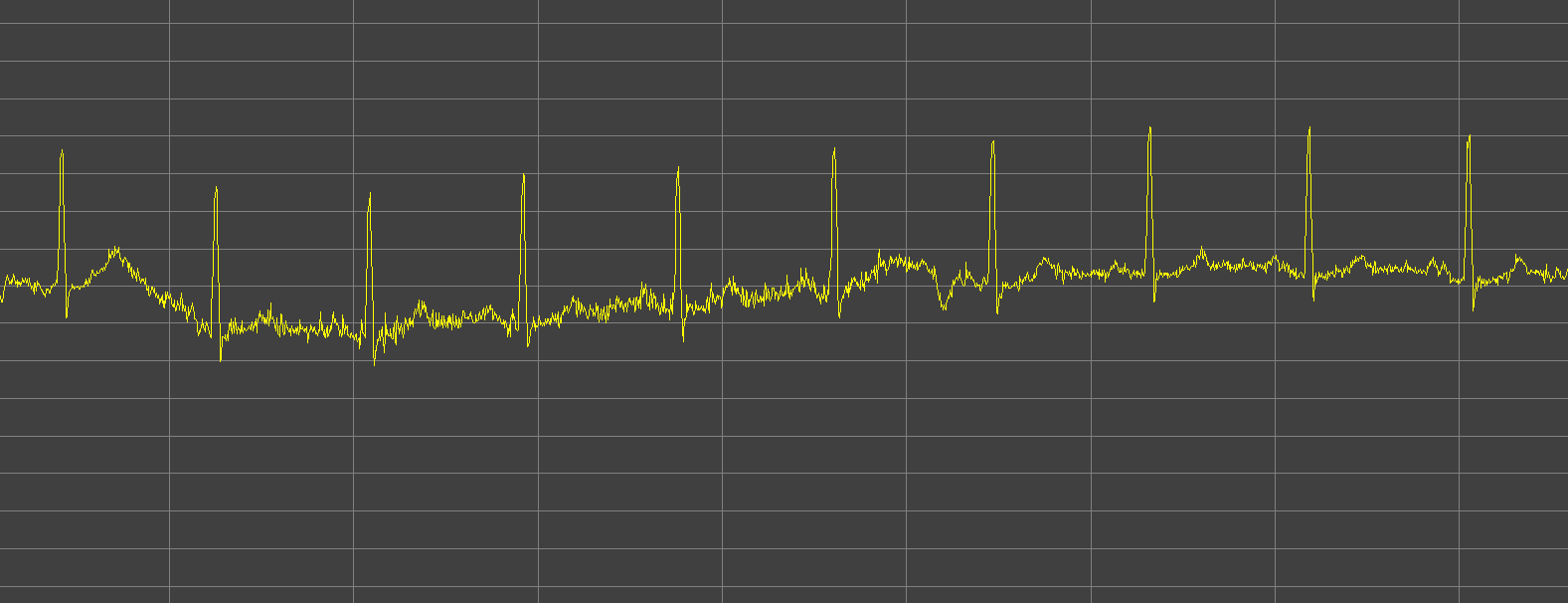 ECG mid noise