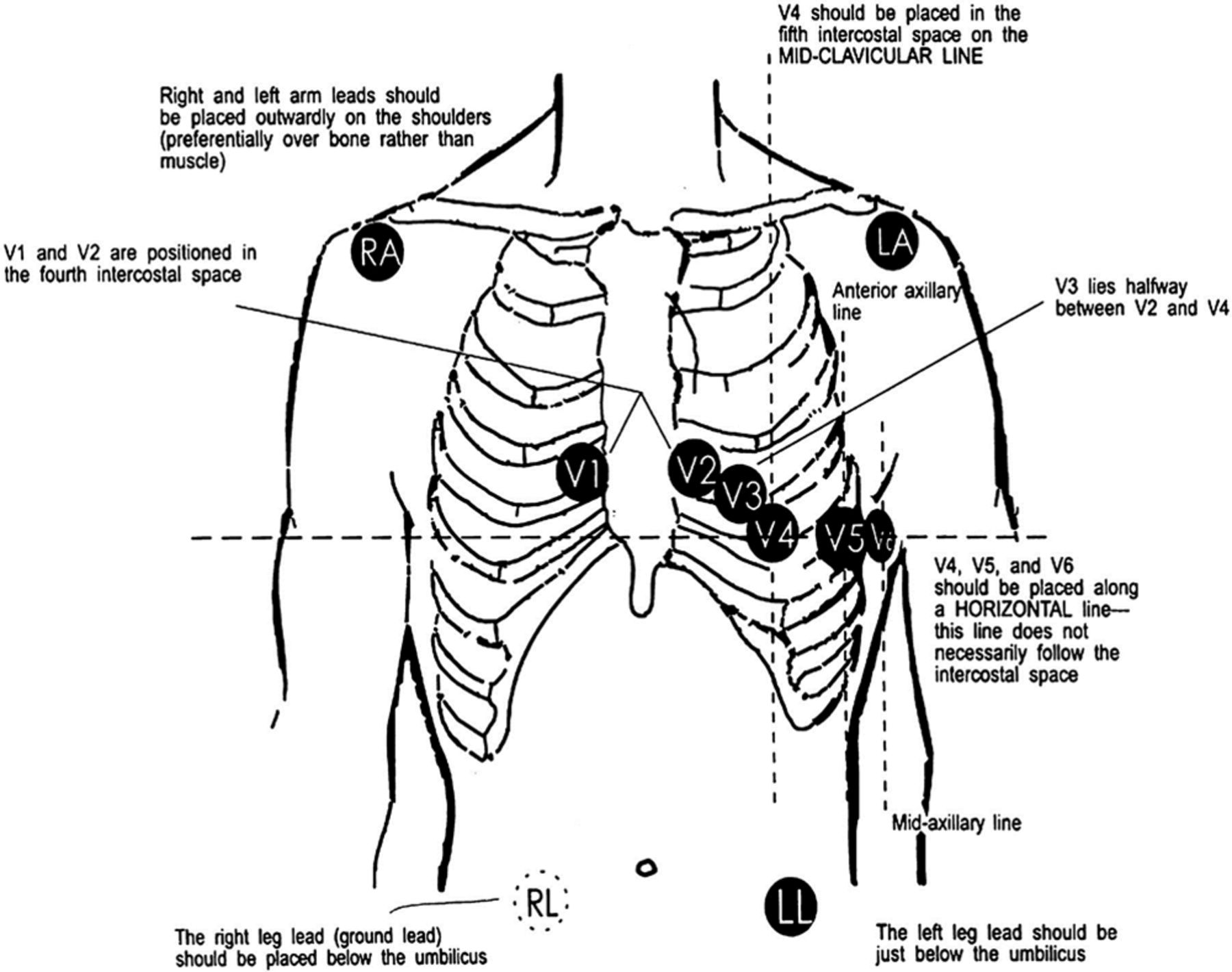 Electrodes positions